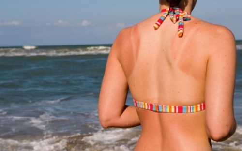 Napégésre házilag